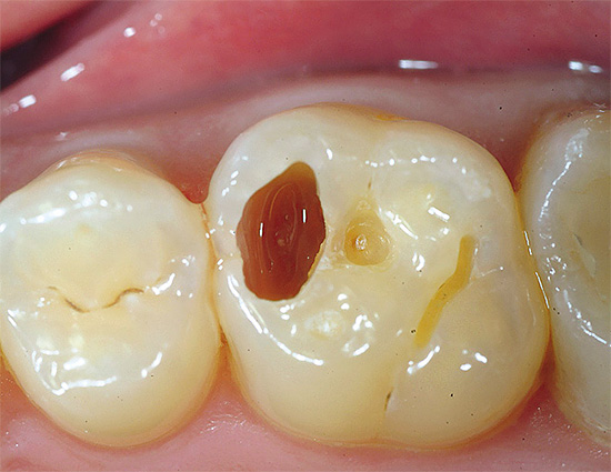 Các khoang sâu răng được làm sạch, các điền cũ được lấy ra.
