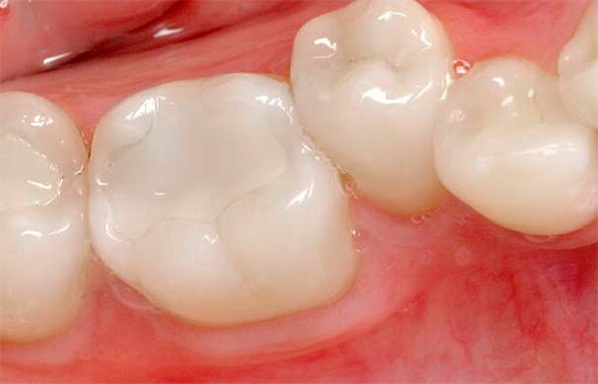 Μερικές φορές μετά την τοποθέτηση μιας σφραγίδας, μπορεί να αισθανθεί πόνος στο δόντι (ευαισθησία μετά την πλήρωση).