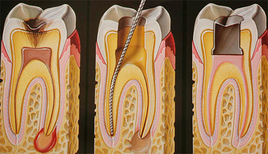 Om utvecklingen av djupa karies har lett till infektion av massan, kommer behandling av tandkanalerna att krävas.