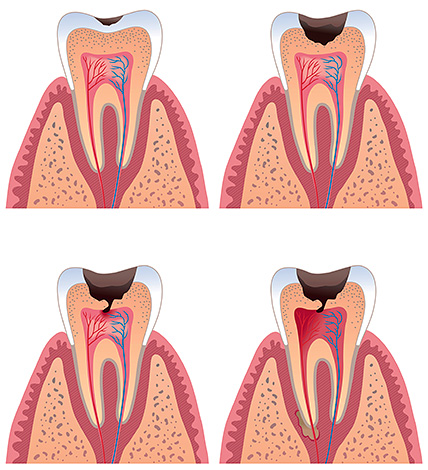 С развитието на кариозния процес кухината се приближава до зъбната каша.