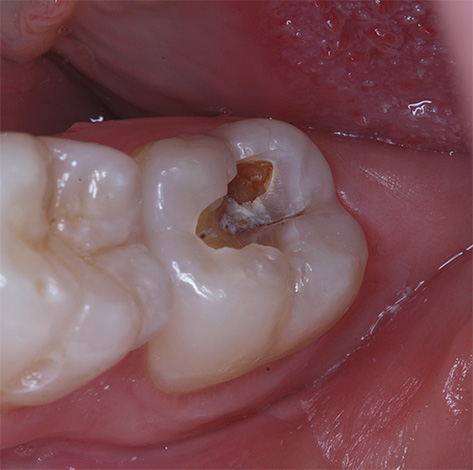 Om tiden inte börjar behandla djupa karies kan den komma till tandens massa (till nerven).