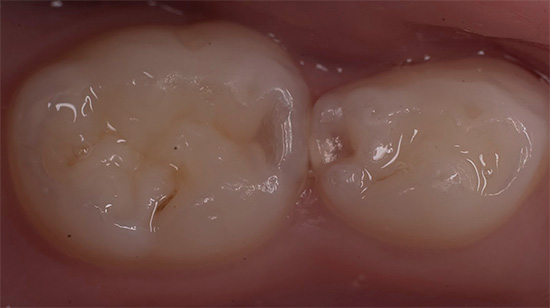 Снимка на зъба, преди да се монтира уплътнението