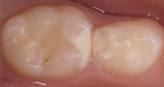 Много зависи от това колко добре се третира зъбът - ако уплътнението е поставено неправилно, то под него може да се появи дълбок кариес (вторичен).
