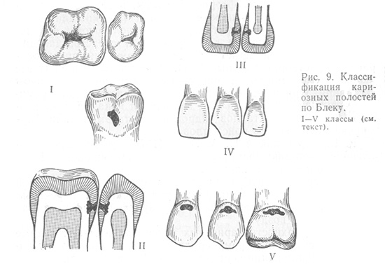 Bilden visar klassificeringen av carious cavities av Black