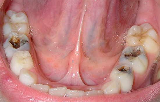 La photo montre clairement les trois dents présentant des lésions carieuses profondes.