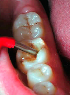 If pulpitis is suspected, differential diagnosis can be performed using electrodontometry.