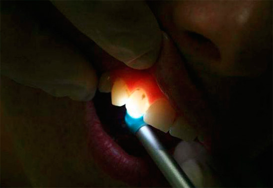 La transillumination est une méthode de diagnostic des caries lorsqu'une dent est éclairée par une source de lumière ponctuelle très lumineuse.