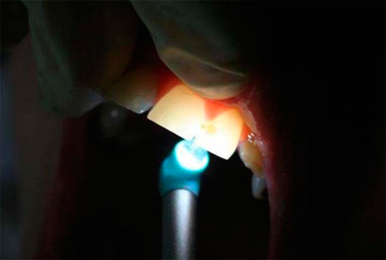 Due to the translucency of the teeth in bright light, you can identify foci of caries.