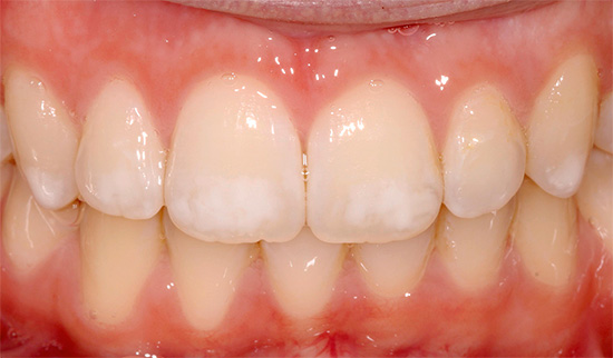 Fotografia prezintă un exemplu de fluoroză - pe dinți există o mulțime de pete albe, dar acesta nu este carii