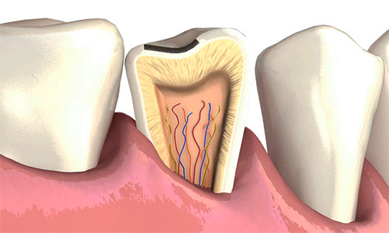 Emaye üzerinde kayda değer yongalar varsa, bunları zamanla iyileştirmek önemlidir, çünkü dişlerin içinden derin bir çürük sürecin gelişmesi mümkündür.