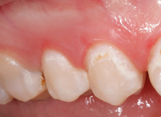ภาพแสดงตัวอย่างของโรคฟันผุในขั้นตอนการย้อมสี - เป็นรูปแบบเริ่มต้นของกระบวนการทางพยาธิวิทยา