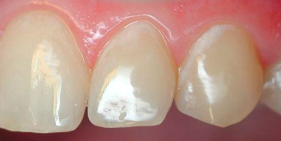 Niet iedereen die dergelijke witte vlekken op zijn tanden heeft aangetroffen, zal zich realiseren dat het gaat om cariës.