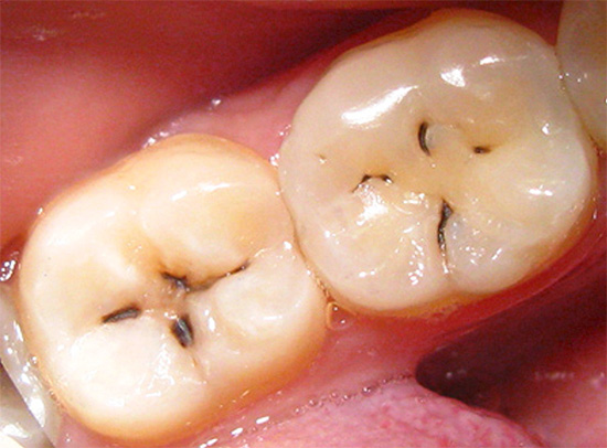 Um exemplo de cárie visualmente bem visível na forma de manchas escuras e listras na fissura do dente.