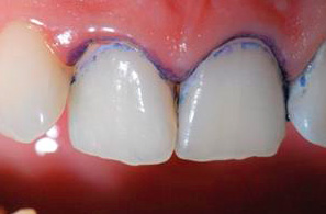 Diagnosis of caries at the initial stage can be carried out using special carving solutions.
