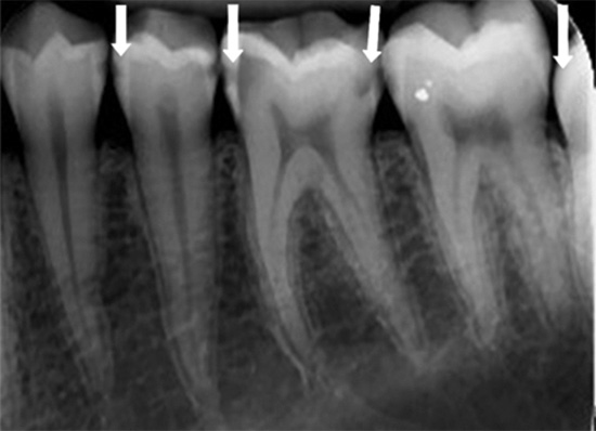 दांतों के इस roentgenogram के उदाहरण पर, अंतःविषय क्षय के अनुरूप काले क्षेत्रों स्पष्ट रूप से दिखाई दे रहे हैं।