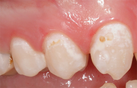 Con la carie iniziale nella fase di macchie bianche e anche altamente pigmentate, il trattamento dentale può spesso essere effettuato con metodi conservativi, è solo importante iniziare in tempo ...
