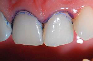 Methylene blue stained areas with initial caries