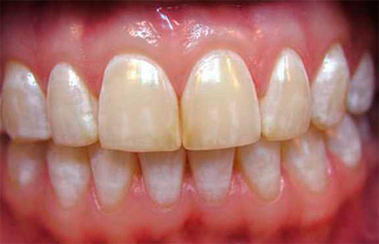 Meerdere witachtige vlekken, symmetrisch gelegen op de tanden met dezelfde naam, zijn kenmerkend voor fluorose.