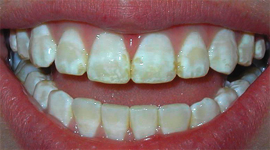 Ein weiteres Beispiel für fleckigen Zahnschmelz als Folge von Fluorose.