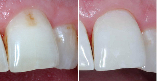 โรคฟันผุเริ่มต้นในขั้นตอนการย้อมสีสามารถหายได้โดยไม่ใช้สว่าน