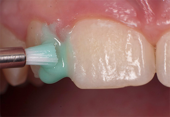 За възстановяване на структурата на зъбния емайл се третира със съединения на калций, фосфор и флуор.