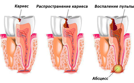 तस्वीर रूट क्षेत्र में बाद में सूजन के साथ दाँत में गहरी क्षरणों का फैलाव दिखाती है।