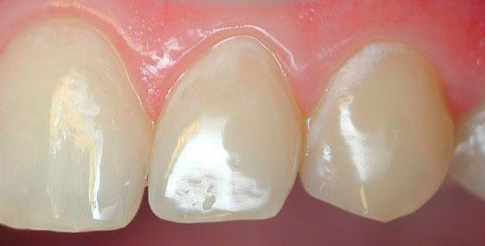 The photo shows the initial caries in the stage of white spots in the cervical area