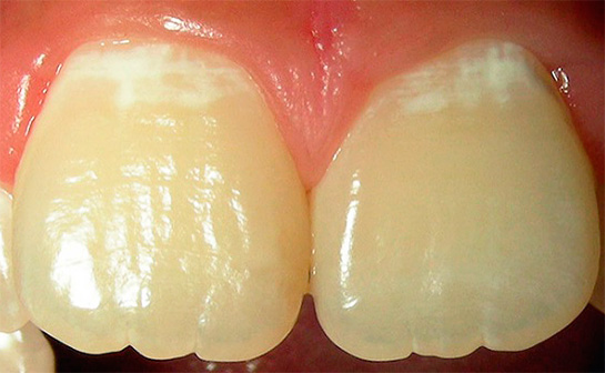 นี่เป็นอีกตัวอย่างหนึ่งของโรคฟันผุเริ่มต้นที่ฟันหน้า
