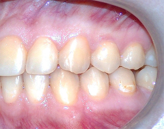 여러 가지 치아는 어떤 표면에서도 발생할 수 있습니다.