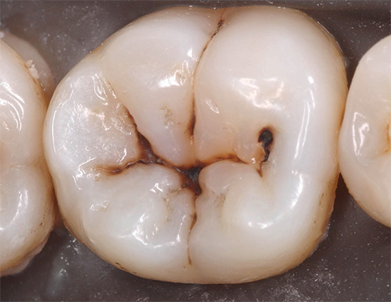 Initiële cariës in het stadium van donkere vlekken (gepigmenteerd) in de tandkloven