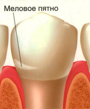 Der Verlust des Glanzes des Zahnschmelzes und seine Weißfärbung in der Zone des kariösen Prozesses führen zum Auftreten des sogenannten Kreidespots
