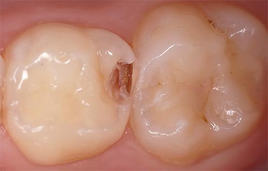 Das Vorhandensein von kariogenen Mikroorganismen in der Mundhöhle bedeutet nicht, dass Zahnkaries auftreten wird.