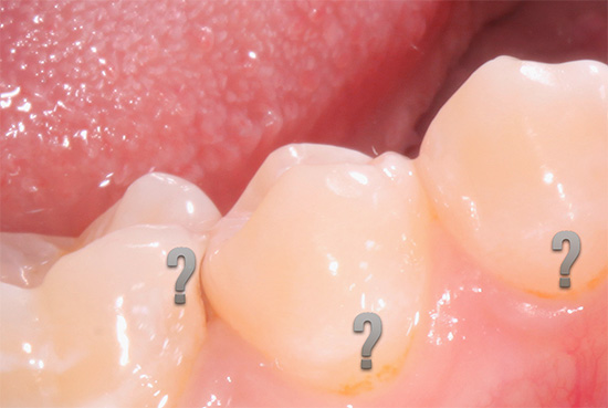 Parlons des caractéristiques de la carie dentaire cachée, de son apparence et de ses dangers potentiels ...