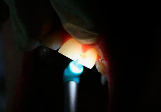 Lorsque la dent est illuminée, la zone touchée par la carie devient clairement visible.
