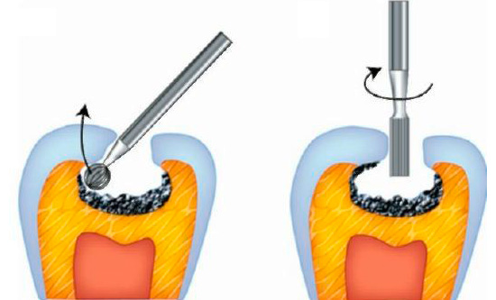 Un ejemplo de la preparación de cavidades cariosas en la fisura del diente.