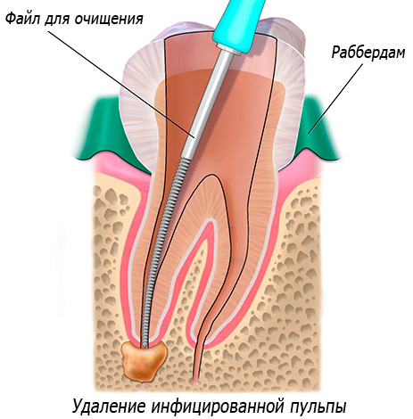 La imagen muestra esquemáticamente la limpieza de los conductos dentales.