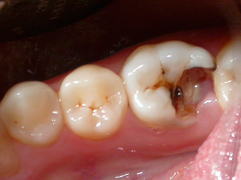 Así es como se ve un diente que fue muy destruido por caries antes del tratamiento