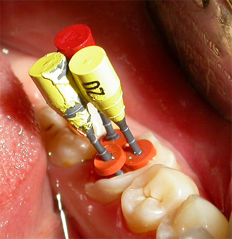 Il est important de décaper complètement et d'antiseptiser chaque canal dentaire.