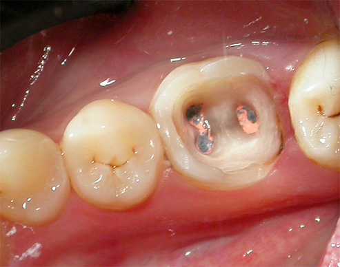 Et voici comment se présente la dent après la procédure de dépulpage, mais la languette de la tige n’est toujours pas installée.
