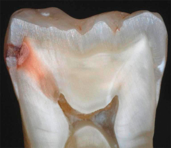 La photo montre un exemple de ce que sont les caries cachées sur une vraie section de dent: auparavant, la zone carieuse était cachée à la place du contact des dents voisines et ne se détachait pas vers l'extérieur.