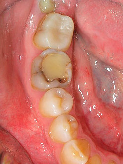 Un processus carien peut se développer à la fois sous le plombage et à la limite de son ajustement à la dent.