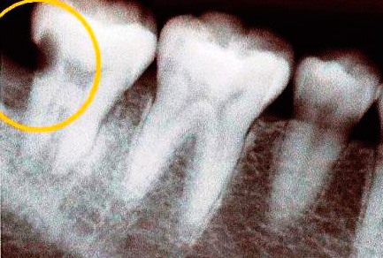 Sur la radiographie est clairement visible la cavité carieuse dans la dent.