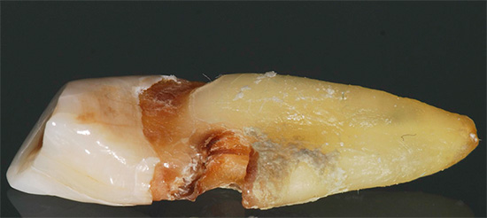 La foto muestra un ejemplo de cuándo la caries oculta en el área de la raíz del diente dio como resultado la necesidad de eliminarlo.