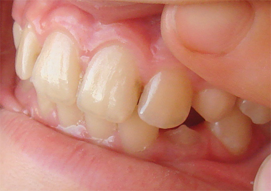 El proceso de caries en el área interdental puede capturar ambos dientes a la vez.