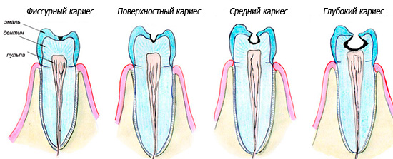 En l'absence de traitement, le processus carieux va progresser, capturant les tissus de plus en plus profonds de la dent.