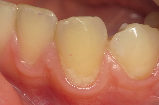 La foto muestra un ejemplo de caries en la etapa de tinción: solo se ve afectado el esmalte dental, el proceso aún es reversible y el tratamiento se puede realizar sin usar un taladro.