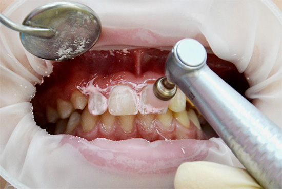 Μηχανικός καθαρισμός των δοντιών πριν από τη θεραπεία τους με αντιδραστήριο αναμίχρωσης