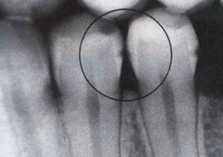 An example of an x-ray of teeth - the presence of hidden interdental caries is evident