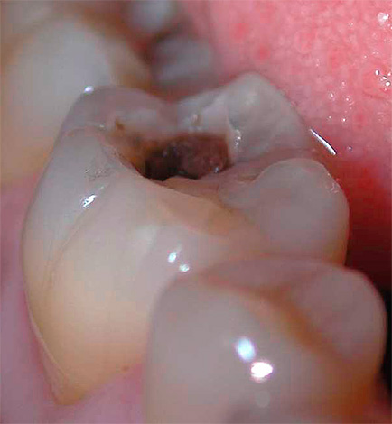 Wenn die Form des kariösen Prozesses vernachlässigt wird, kann eine Entbullung (Entfernung des Zahnnervs) erforderlich sein.
