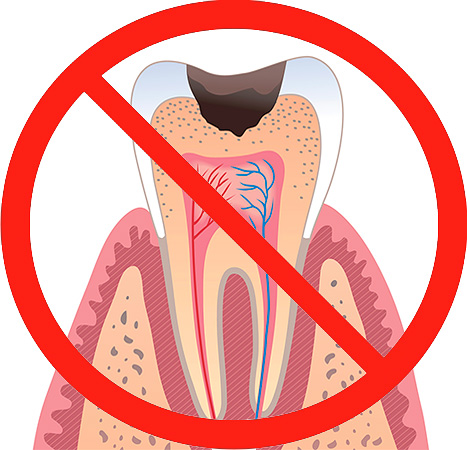 Hoe eerder u naar de tandarts gaat, hoe minder de tand zal worden vernietigd en hoe gemakkelijker het zal zijn om het te behandelen.